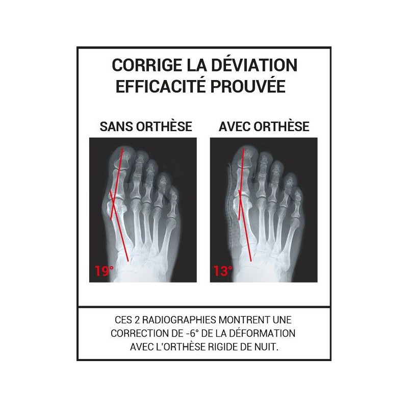 Epitact Orthèse Corrective Rigide De Nuit - Paramarket