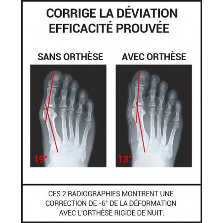 Epitact Orthèse Corrective Rigide De Nuit - Paramarket