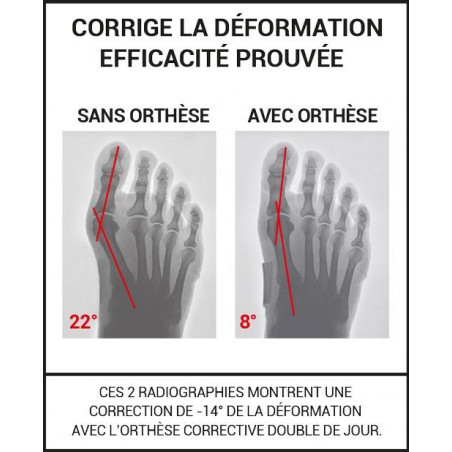 Epitact Orthèse Corrective Double HV - Paramarket