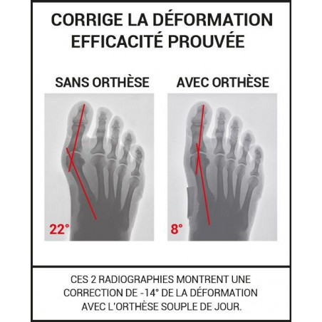 Epitact Orthèse Corrective Souple Jour - Paramarket