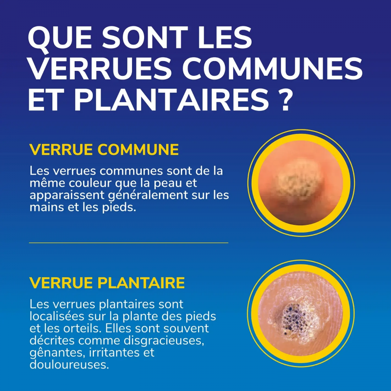 Scholl Traitement verrues Freeze Away MAX mains et pieds – Paramarket.com
