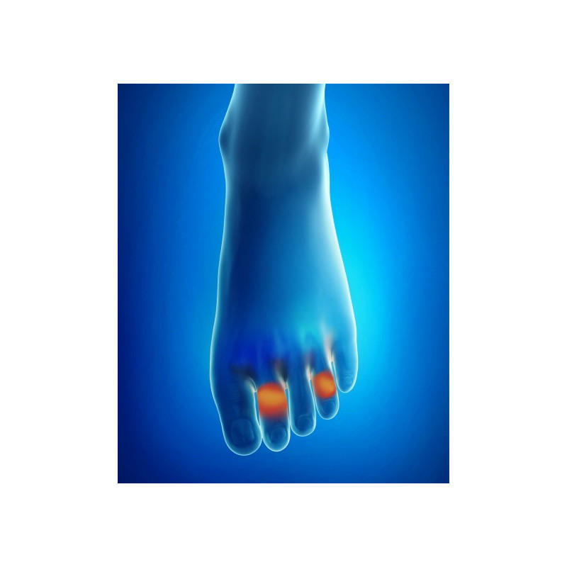 BARRETTES SOUS-DIAPHYSAIRES